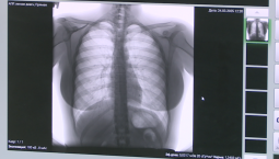 Севастопольцам рассказали об опасности туберкулёза