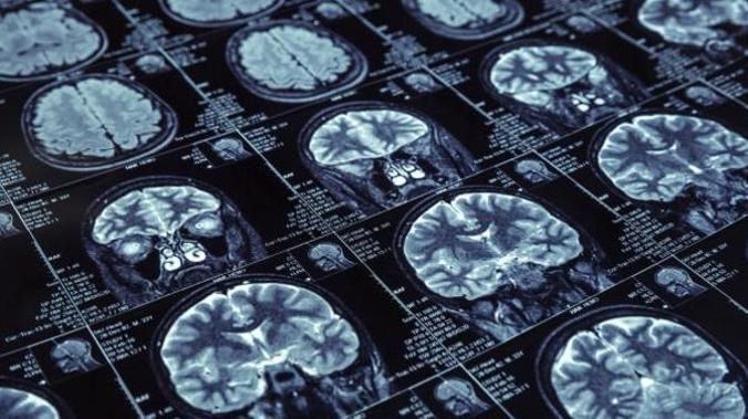 Ученые: COVID-19 может привести к гибели сосудов мозга